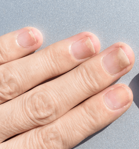 Paronychia, Swollen Finger with Fingernail Bed Inflammation Due To  Bacterial Infection on a Toddlers Hand. Stock Image - Image of human,  inflammation: 163566893