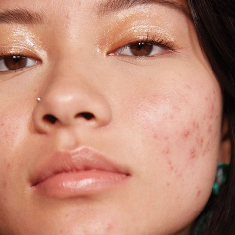 Natural skincare for oily skin
