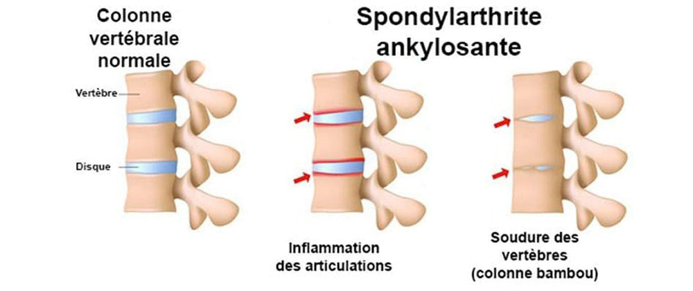 Spondylarthrite ankylosante et douleur de dos nocturne