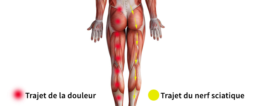 Douleurs nerveuses irradiantes dans la jambe