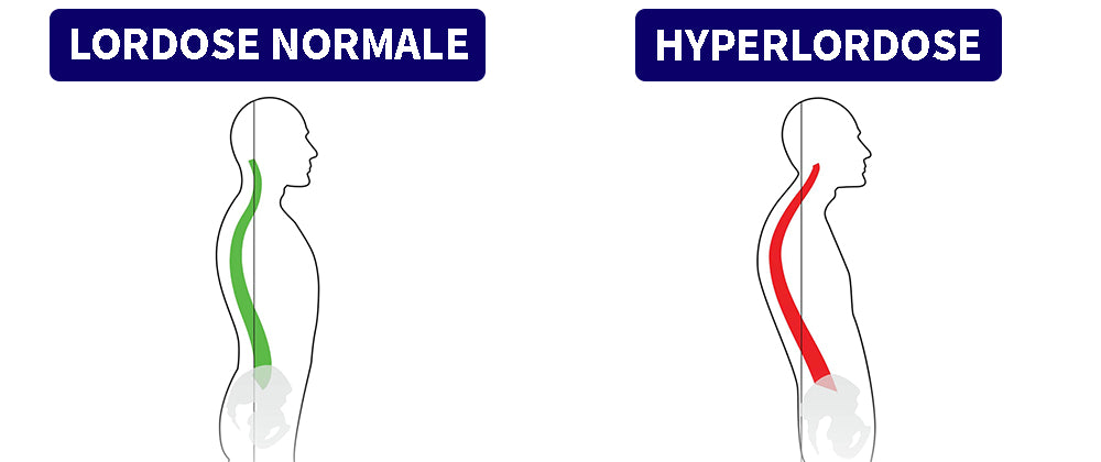 Lordose et hyperlordose : Quelle différence ?