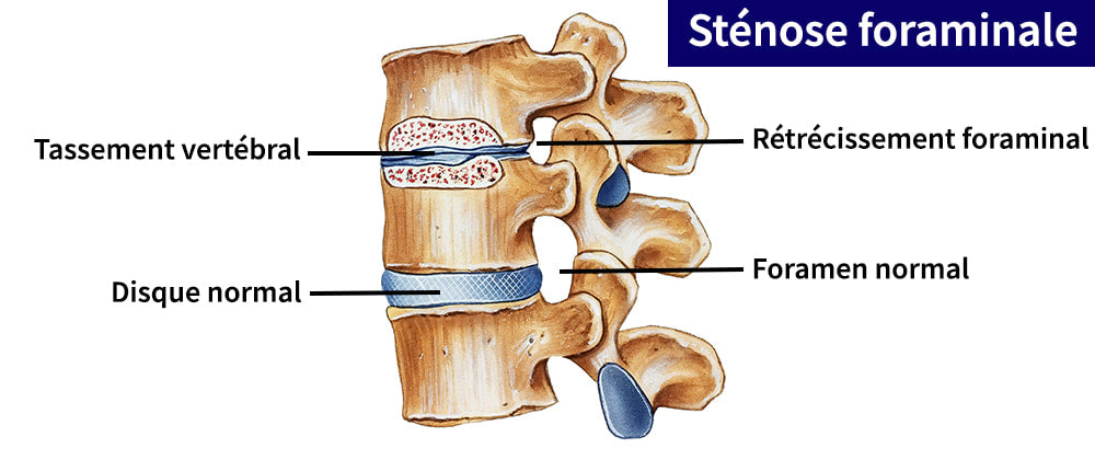 Hernie Discale foraminale : Causes et Traitements | Body Secure