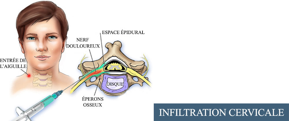 Hernie discale cervicale : Infiltration