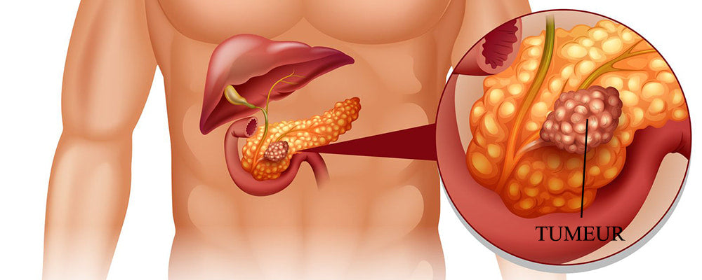 Douleur au dos et Cancer du Pancréas