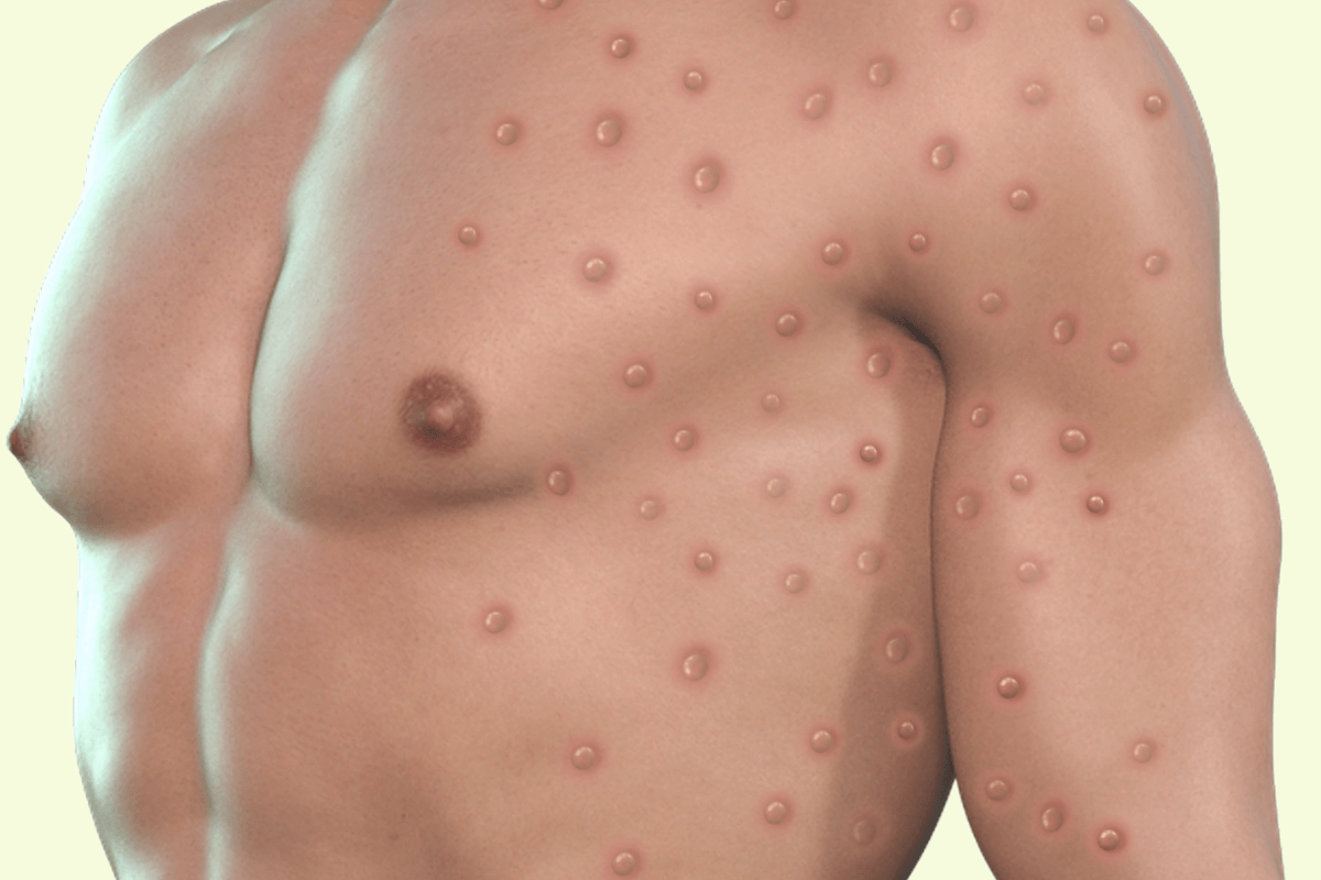 A chest with a rash illustrating the monkeypox virus