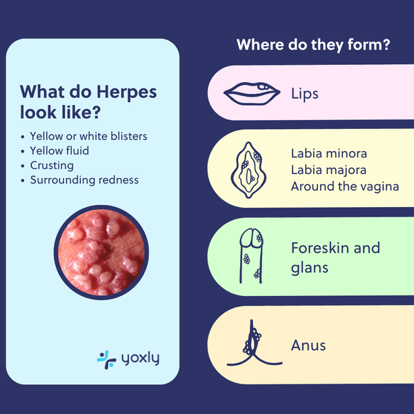 An infographic illustrating how herpes looks like