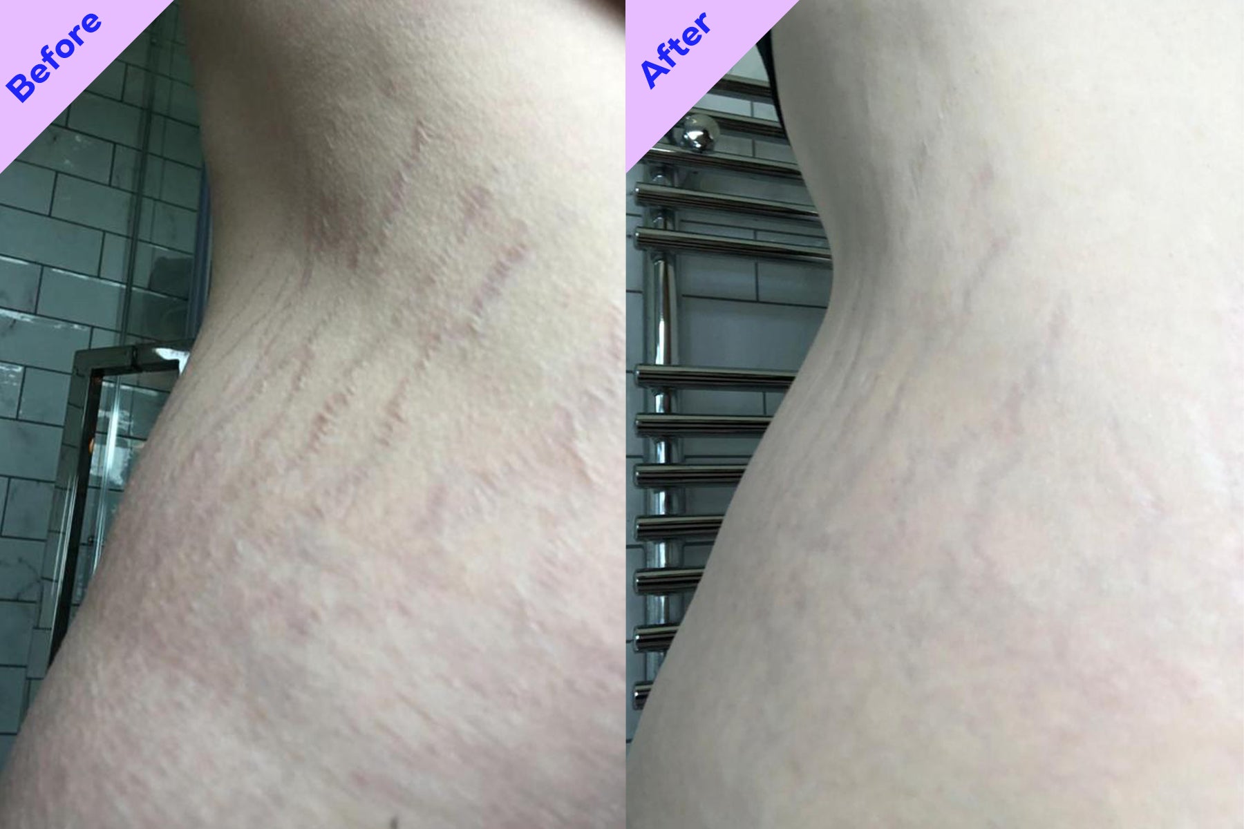 Before and after using And Stretch... Stretch mark cream.