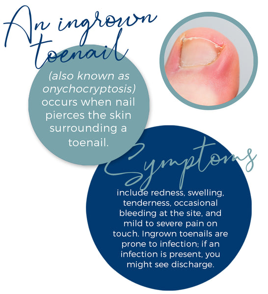 Non-surgical Ingrown Toenail Clinic