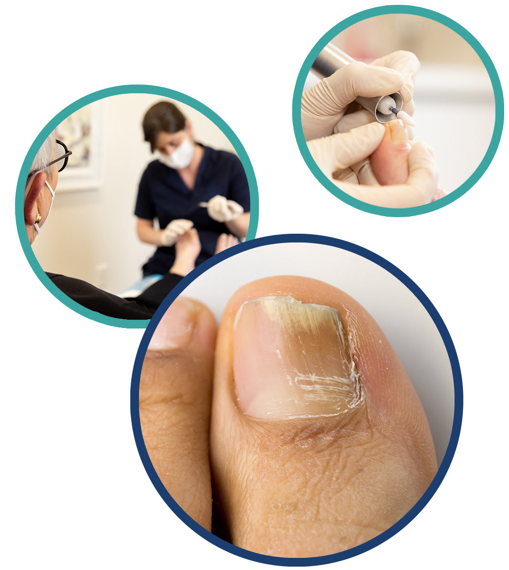 Merivale Podiatry Fungal Nail Infection Pic