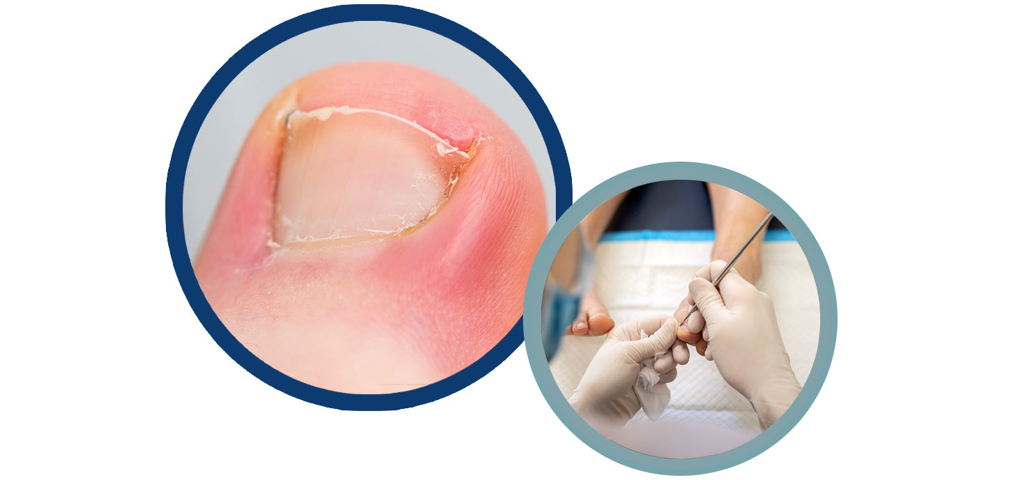 Ingrown Toenails for Loudoun Station, Ashburn, VA | Podo Care Foot & Ankle  | Podiatric Foot & Ankle Specialist & Podiatrist