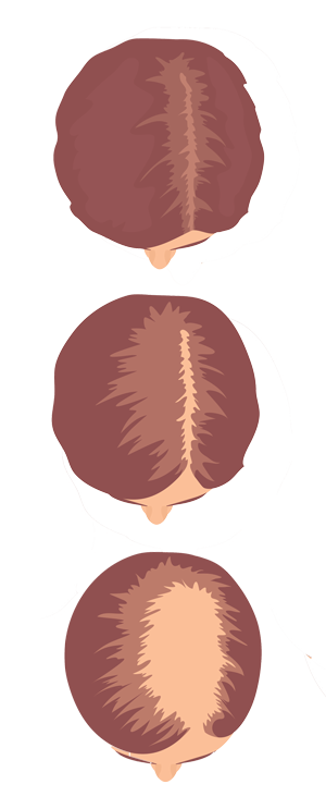 ludwig scale