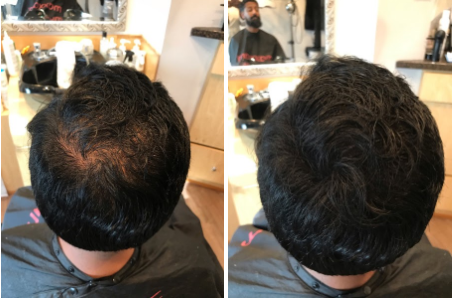 strand builder before and after