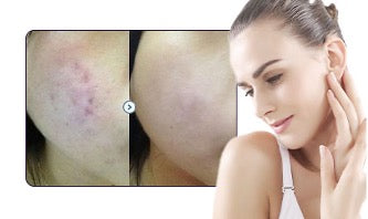 före och efterbild borttagning av acne med C02 laser