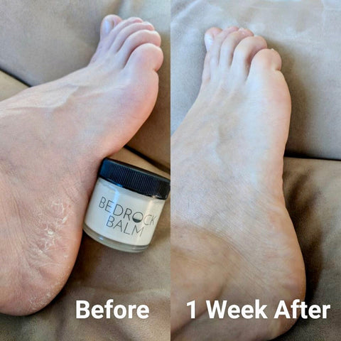 Hydramor Max FOOT Cream For Cracked HEELS & Excessive Dry Thick Skin. –  GLEIN PHARMA