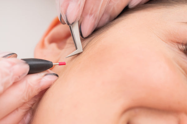 Electrolysis treatment close up