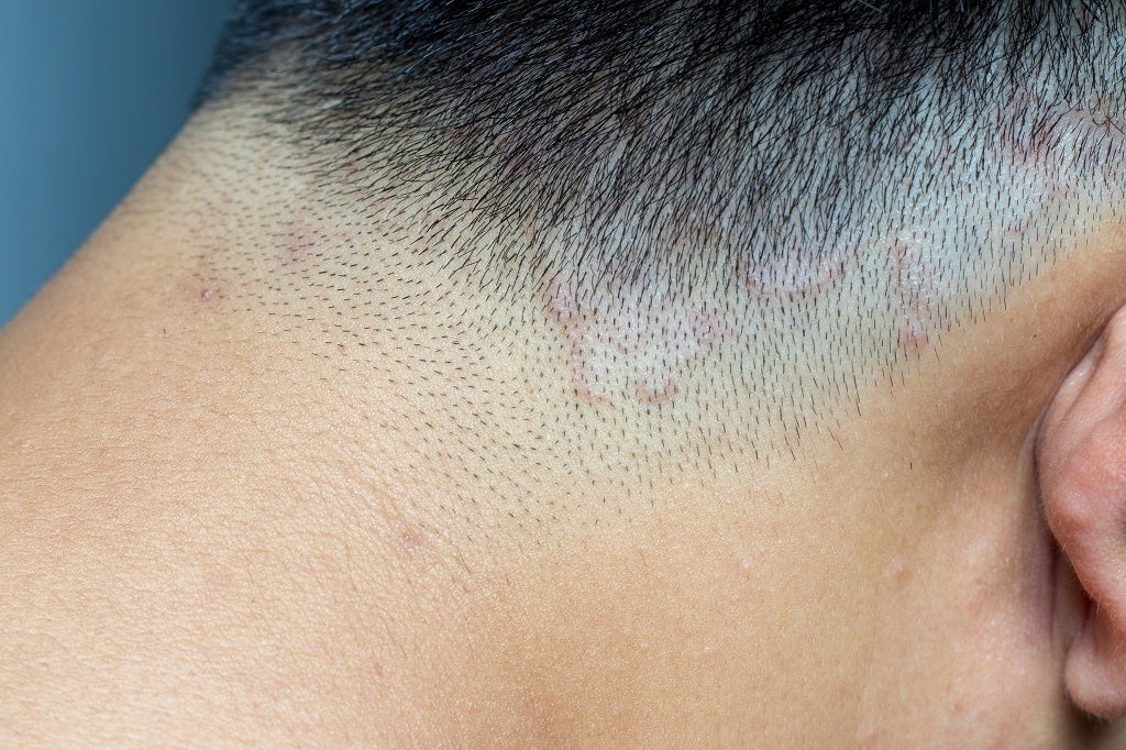 Ringworm Of The Scalp Tinea Capitis Causes Symptoms And Remedies