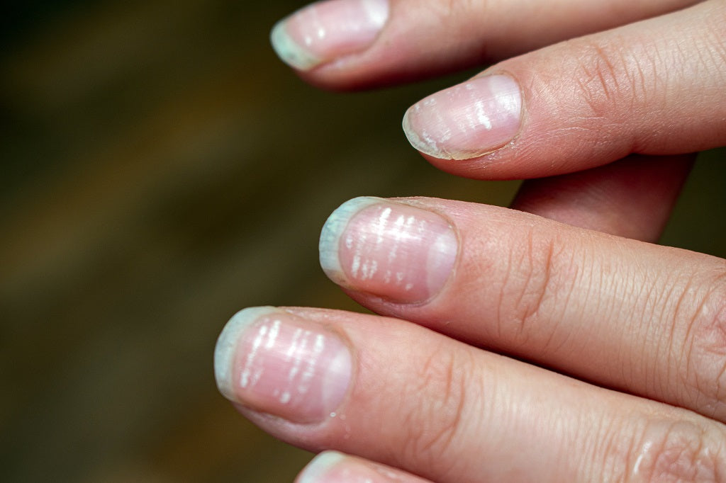 6. Nail Bed Color and Vitamin Deficiency Anemia - wide 5