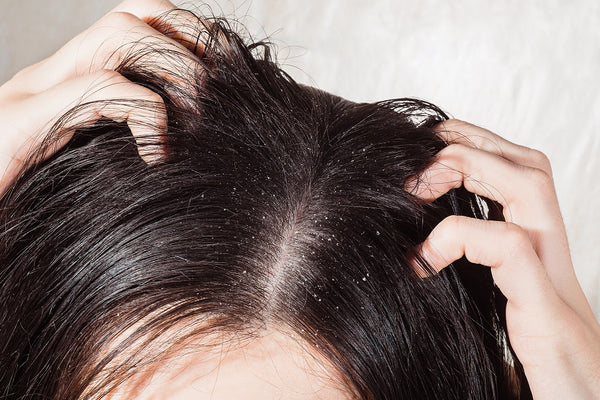  Dandruff And Itchy Scalp