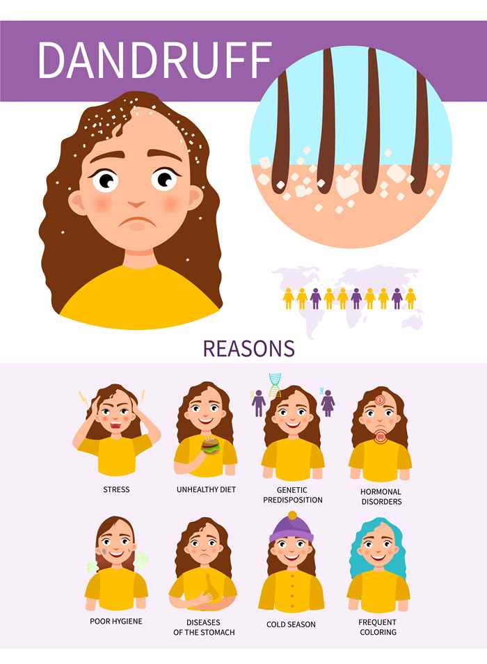 The Reasons Behind Dandruff (Infographic)