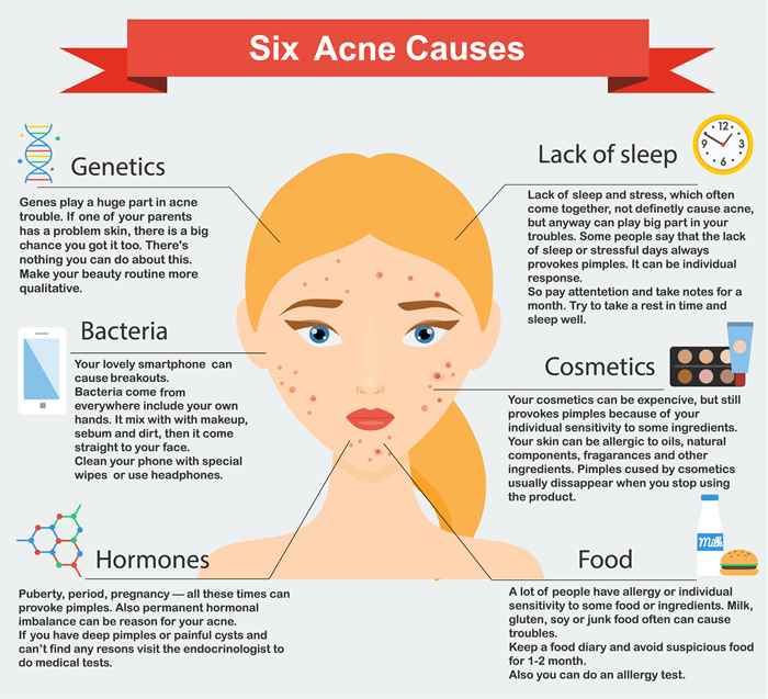 6 Reasons for Acne (Infographic)