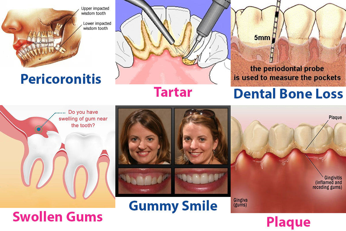 pathological fear of gums