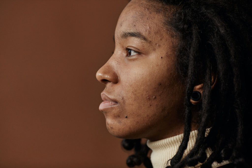 side profile of a woman with acne