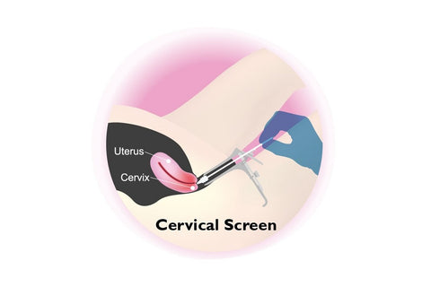 Illustration of a swab of cells being taken from the cervix. 