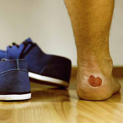 Example of an injury related to barefoot running: Hemorrhagic blister