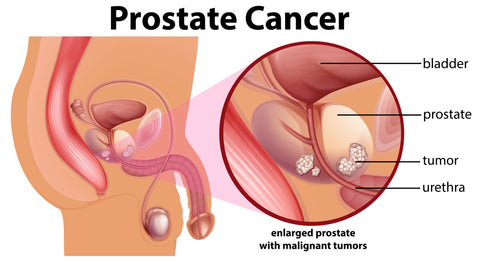 Prostate Cancer