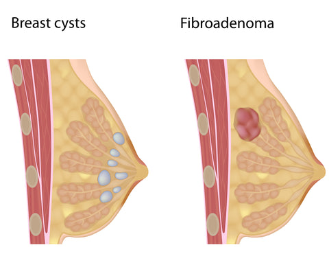 BREAST CYSTS and FIBROADENOMAS