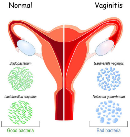 normal-vs-vaginitis-symptons