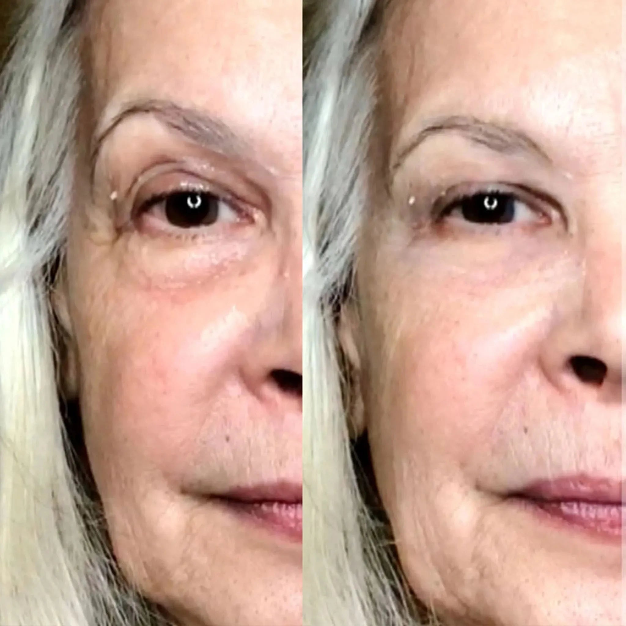 Wrinkles Disappear!