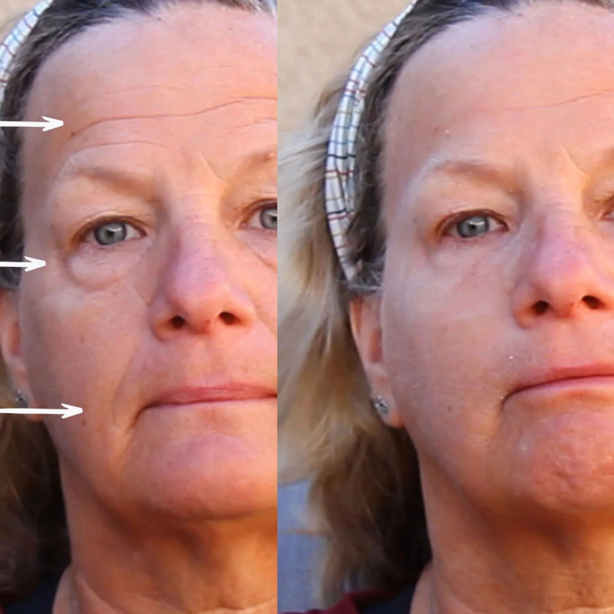 Wrinkles Disappear!