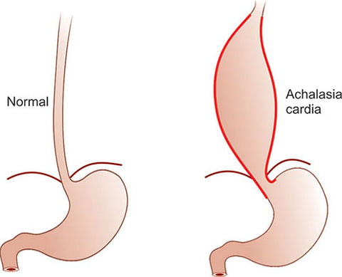 achalasia cardia