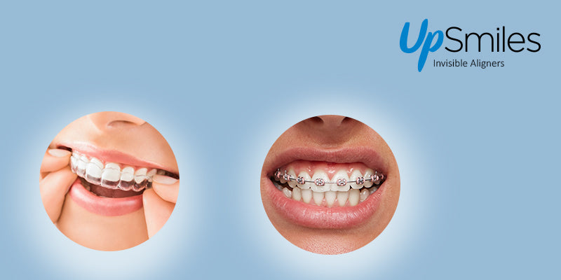 aligners vs braces