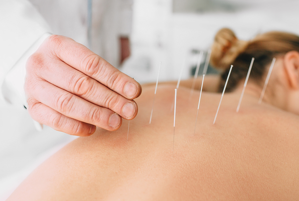 acupuncture for stress