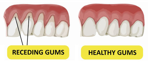 Receding Gums: From Causes to Treatment and Everything in Between ...
