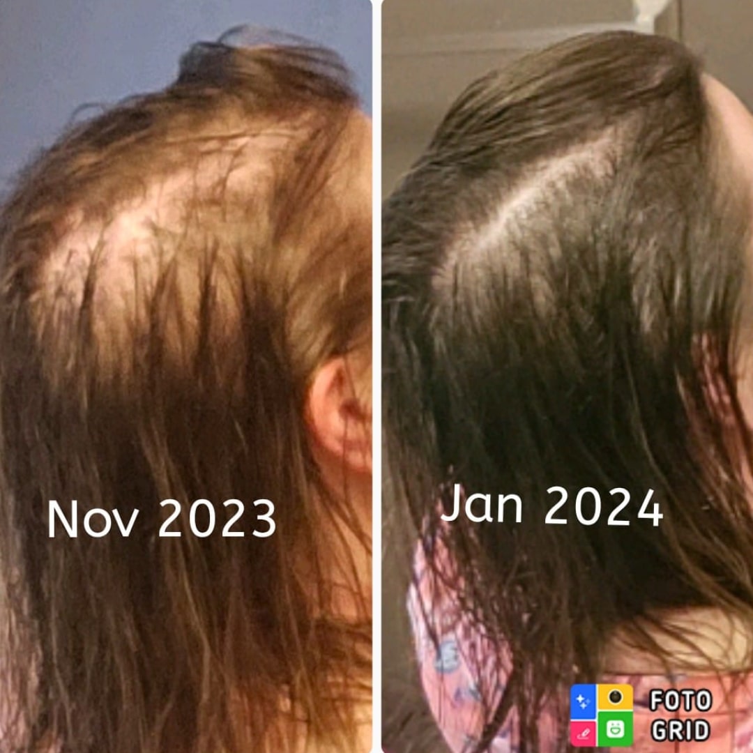 Before and after comparison of hair regrowth between November 2023 and January 2024.