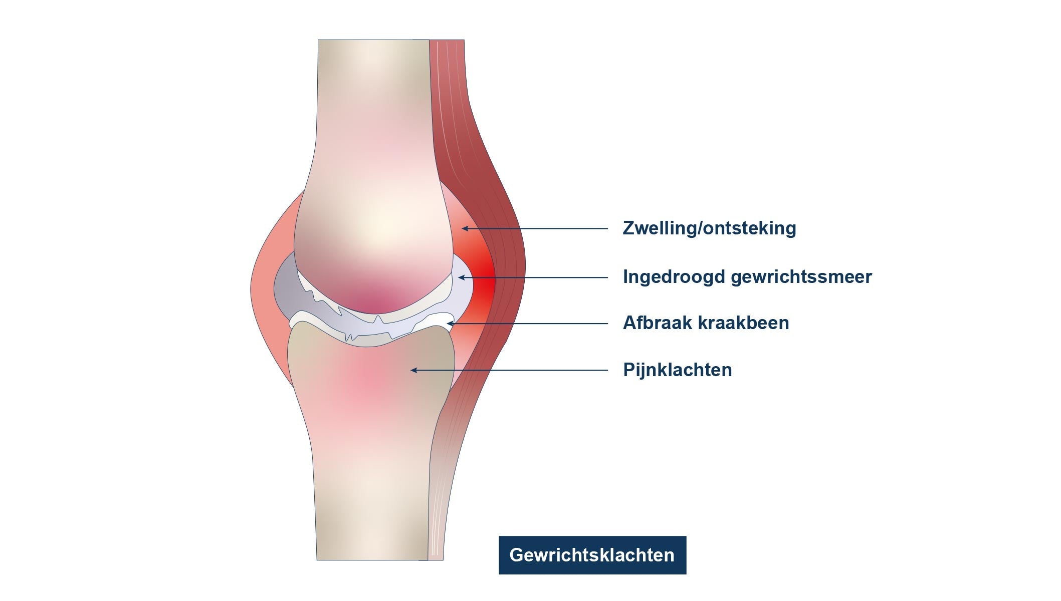 gewrichtsklachten