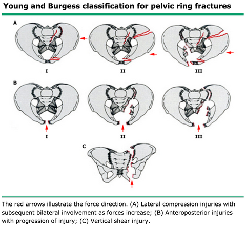 Ask a Pro: Pelvic Instability and Emergency Treatment - Dynamic Rescue ...