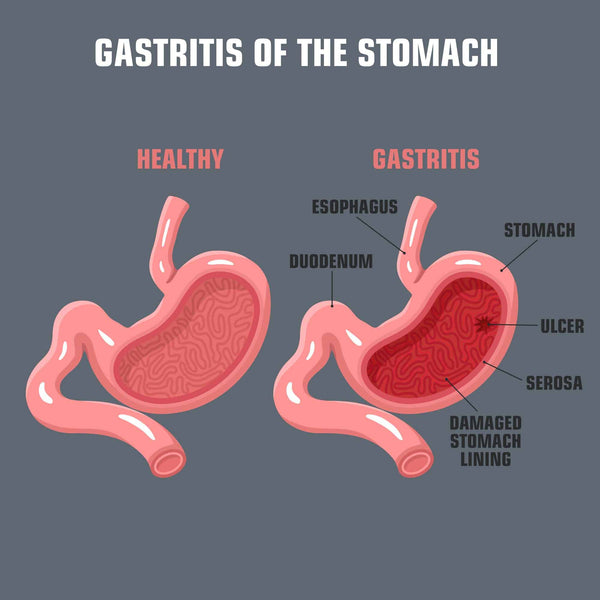 the digestive system and gastritis