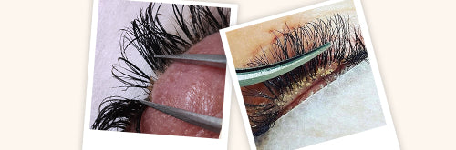 Beware of Blepharitis! - What is Blepharitis?