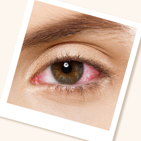 Close-up of eyelash extension client's eye with chemical burns from eyelash extension glue