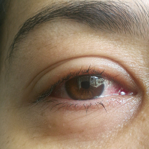 Close-up of allergic reaction eyelash extensions