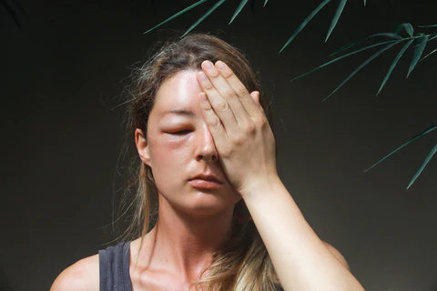Wimpernkundin, die allergisch auf Wimpernverlängerungen reagiert