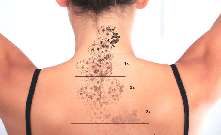 What to Know About Using Tattoos to Cover Scars  Removery