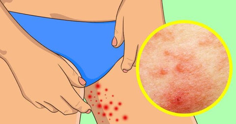 Everything you Wanted to Know About Inner Thigh Chafing & Rashes – Skineasi