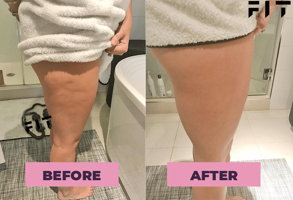 FIT Cellulite Pic