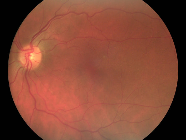 Volk Fundus Examination