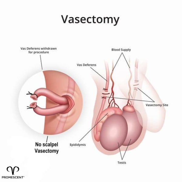 How a Vasectomy Procedure is Performed